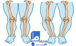 پای پرانتزی 